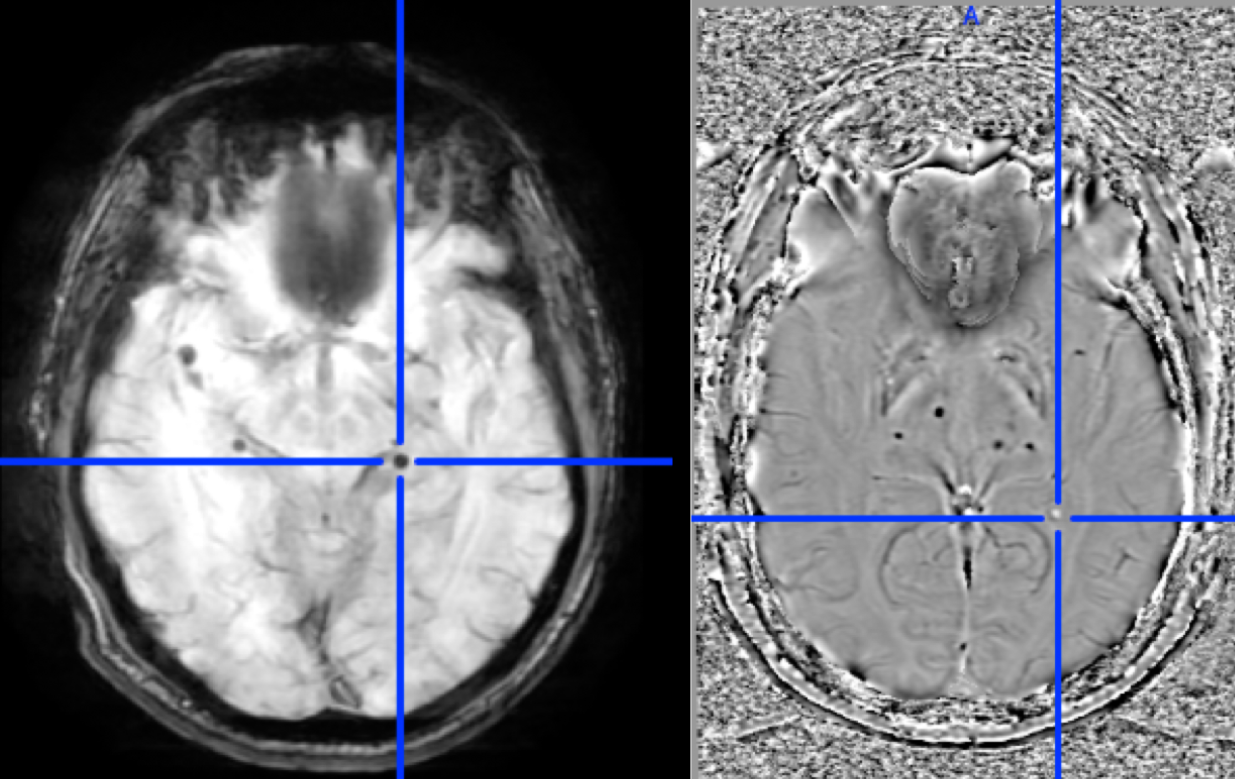 Automated Detection of Cerebral Microbleeds using Radial Symmetry Transform & RUS Boosted Trees